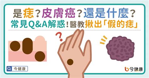 痣 有毛|是痣？皮膚癌？還是什麼？常見Q&A解惑！醫教揪出「。